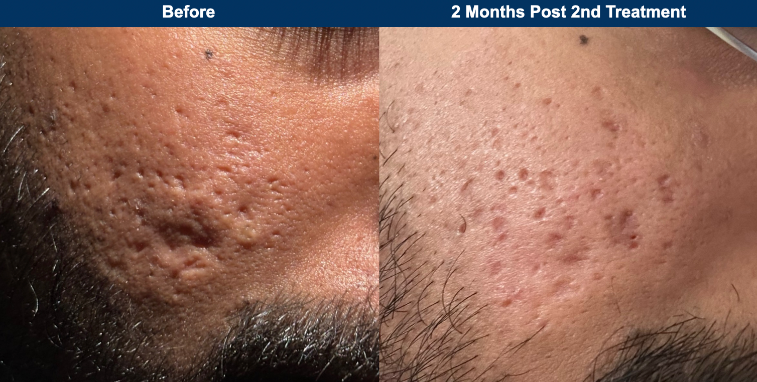 UltraClear Laser Skin Resurfacing