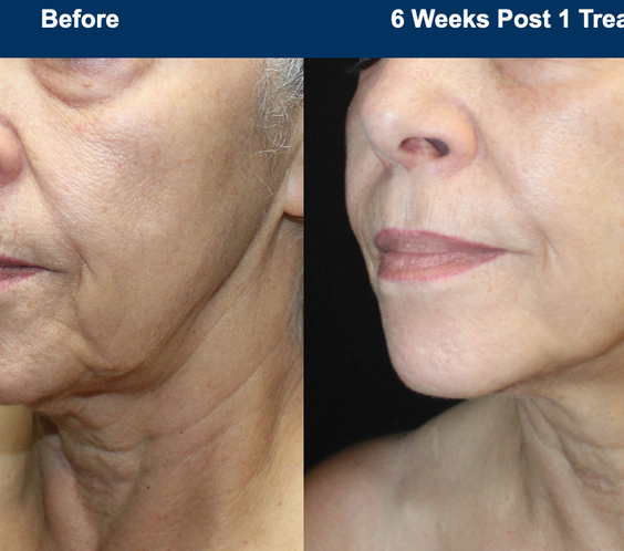 UltraClear Laser Skin Resurfacing