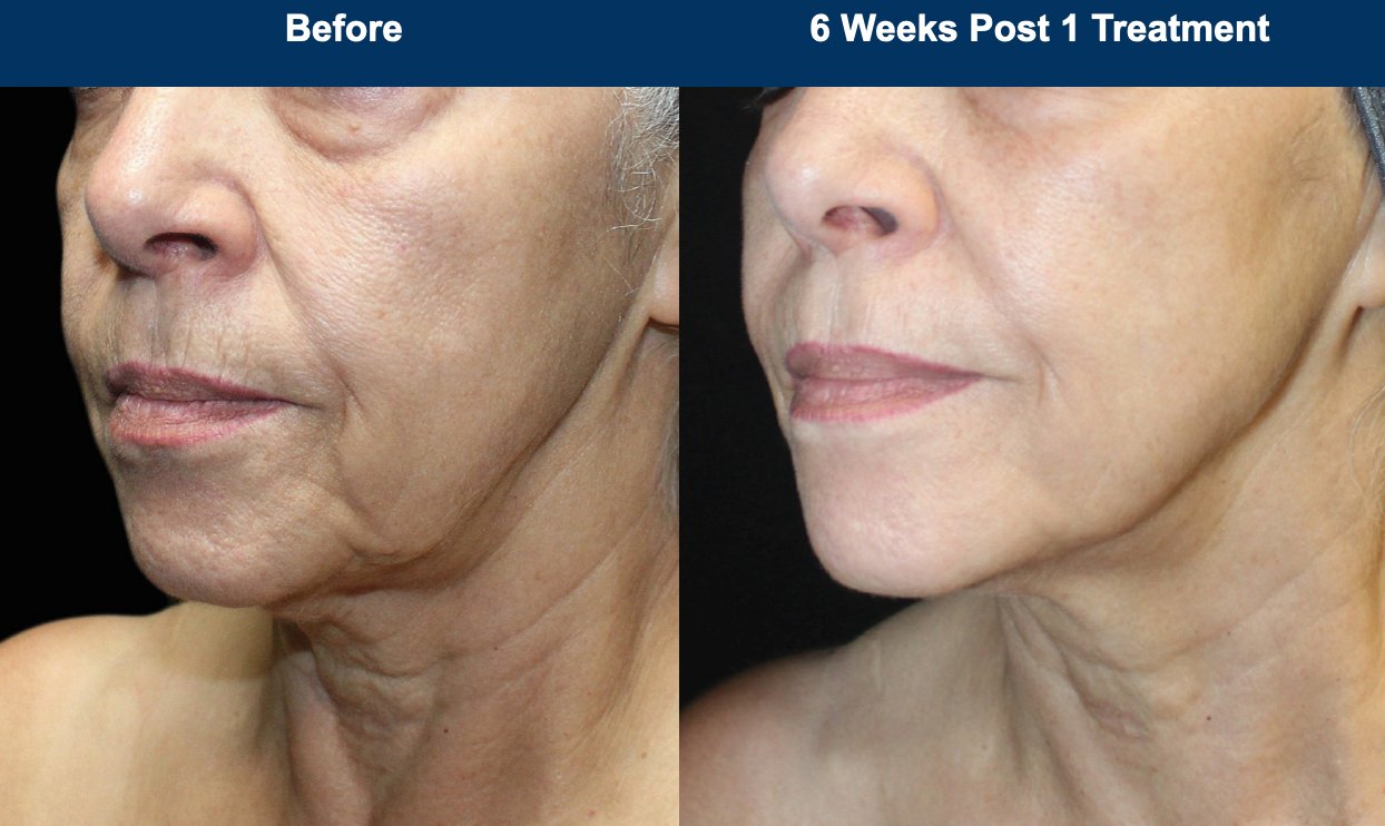 UltraClear Laser Skin Resurfacing