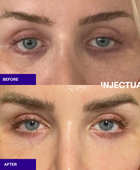 Salmon Sperm Facial Polynucleotides  rejuvenate under eye and face  before and after 