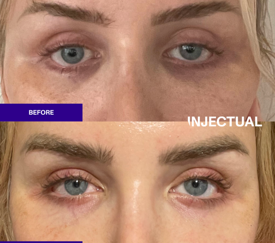 Salmon Sperm Facial Polynucleotides  rejuvenate under eye and face  before and after 