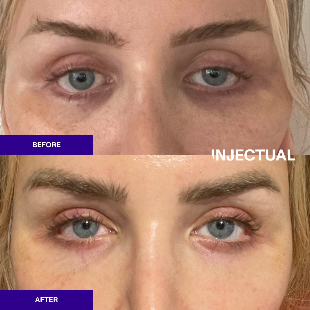 Ameela polynucleotides rejuvenate under eye before and after 