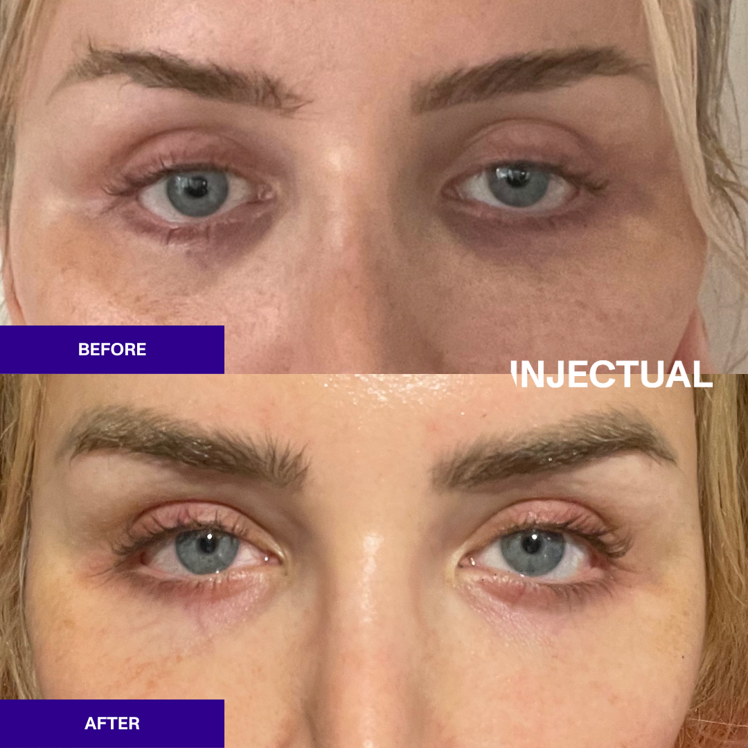 Get Rid Of Eye Bags Without Surgery | Victorian Dermal Group