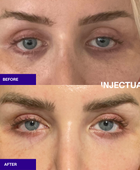 Ameela polynucleotides rejuvenate under eye before and after 