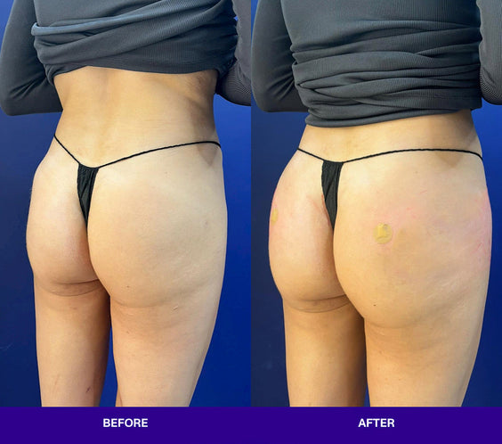 Injectual Buttocks Filler Treatment
