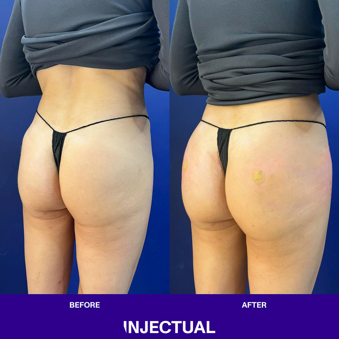 Injectual Buttocks Filler Treatment