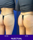 Injectual Buttocks Filler Treatment