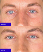 Salmon Sperm Facial Polynucleotides  rejuvenate under eye and face  before and after 