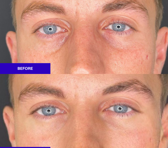 Salmon Sperm Facial Polynucleotides  rejuvenate under eye and face  before and after 