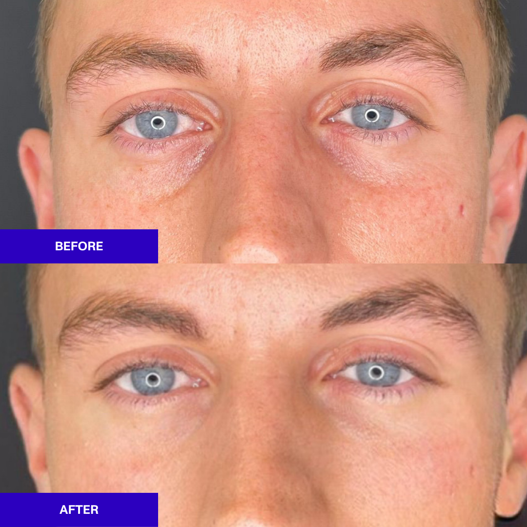 Ameela polynucleotides rejuvenate under eye before and after 