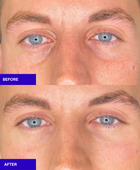 Ameela polynucleotides rejuvenate under eye before and after 