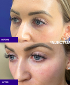 Salmon Sperm Facial rejuvenate under eye and face  before and after 