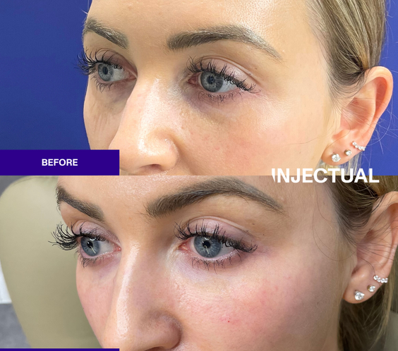 Salmon Sperm Facial rejuvenate under eye and face  before and after 