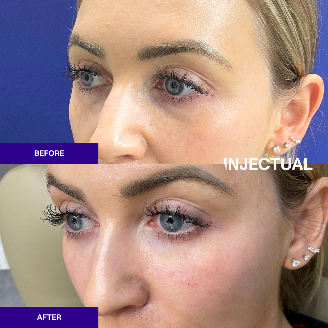 Ameela polynucleotides rejuvenate under eye before and after 