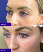 Ameela polynucleotides rejuvenate under eye before and after 