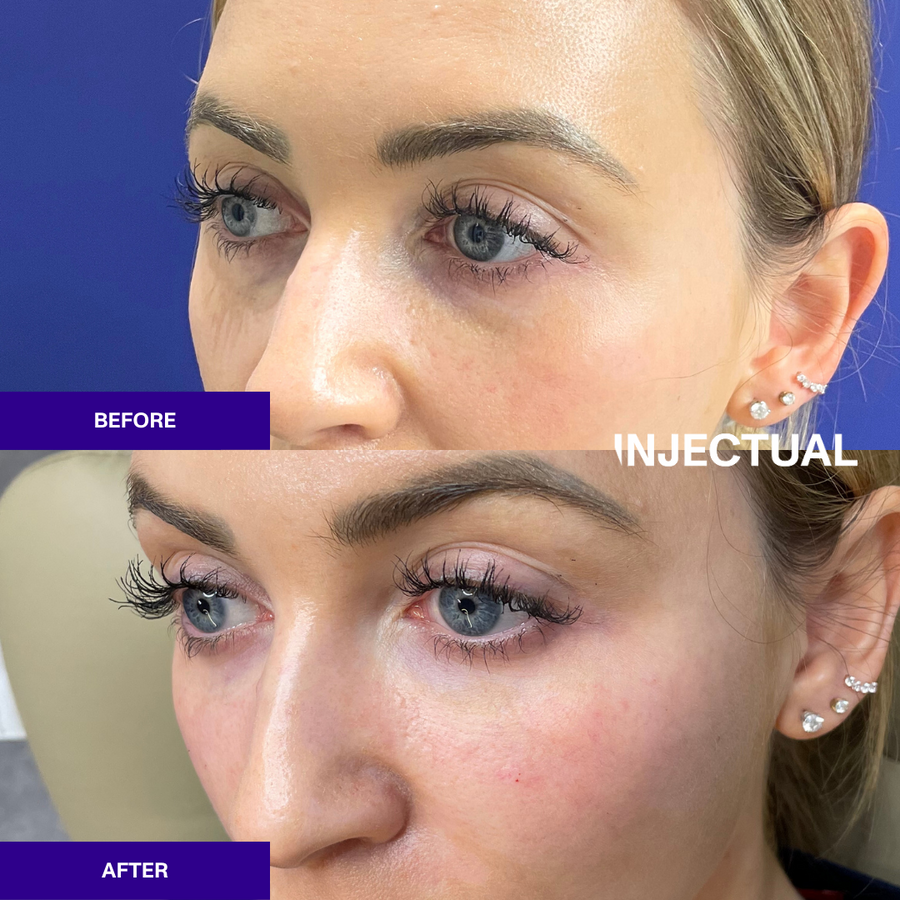 Polynucleotides Ameela® (Nucleadyn®) Under Eye Treatment