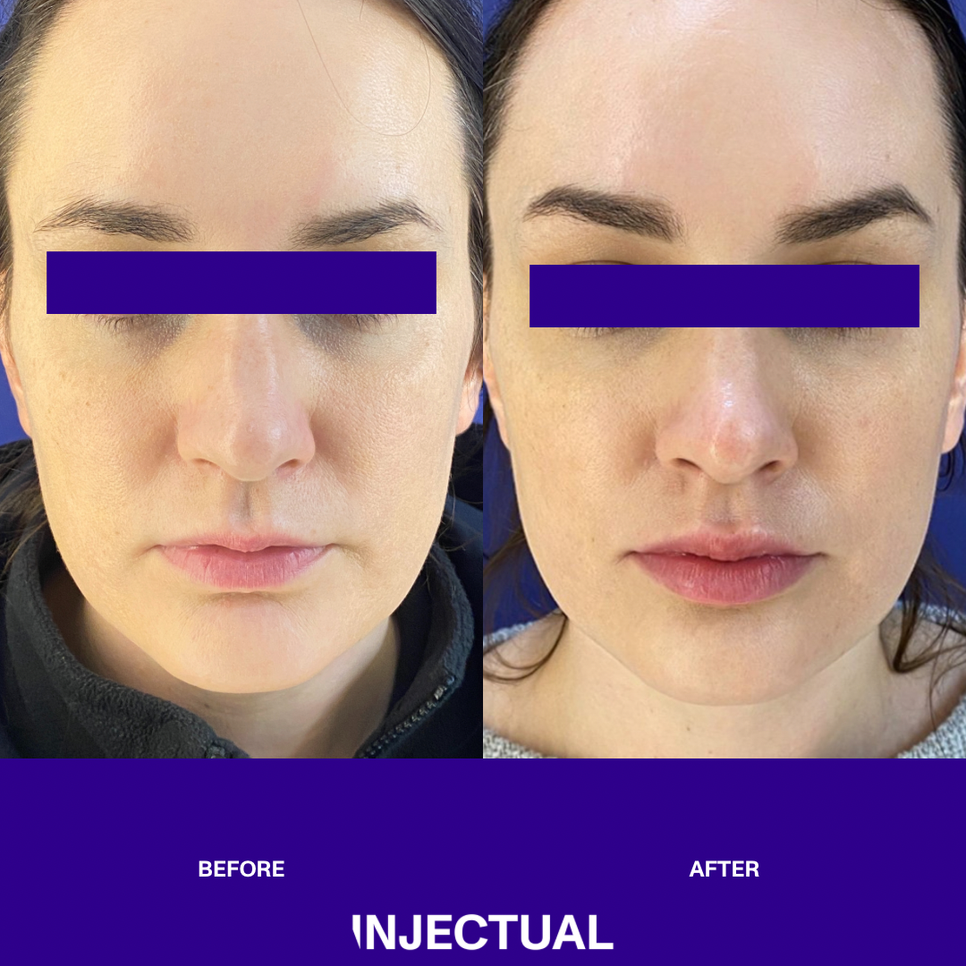 Polynucleotides Ameela® (Nucleadyn®) Under Eye Treatment