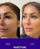 Salmon Sperm Facial rejuvenate under eye and face  before and after 