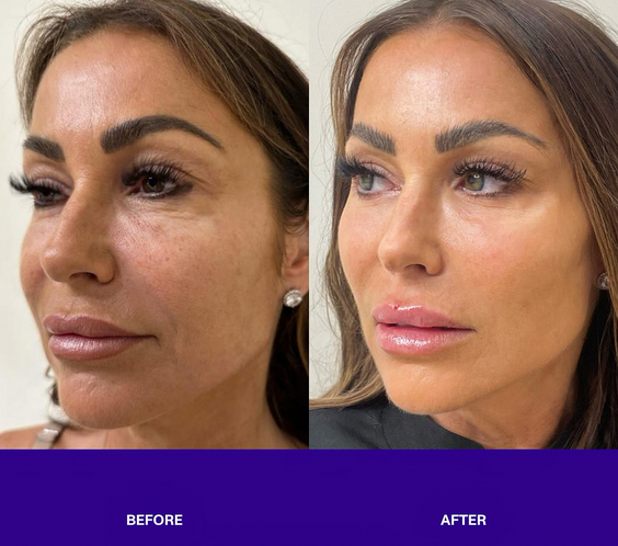 Salmon Sperm Facial rejuvenate under eye and face  before and after 