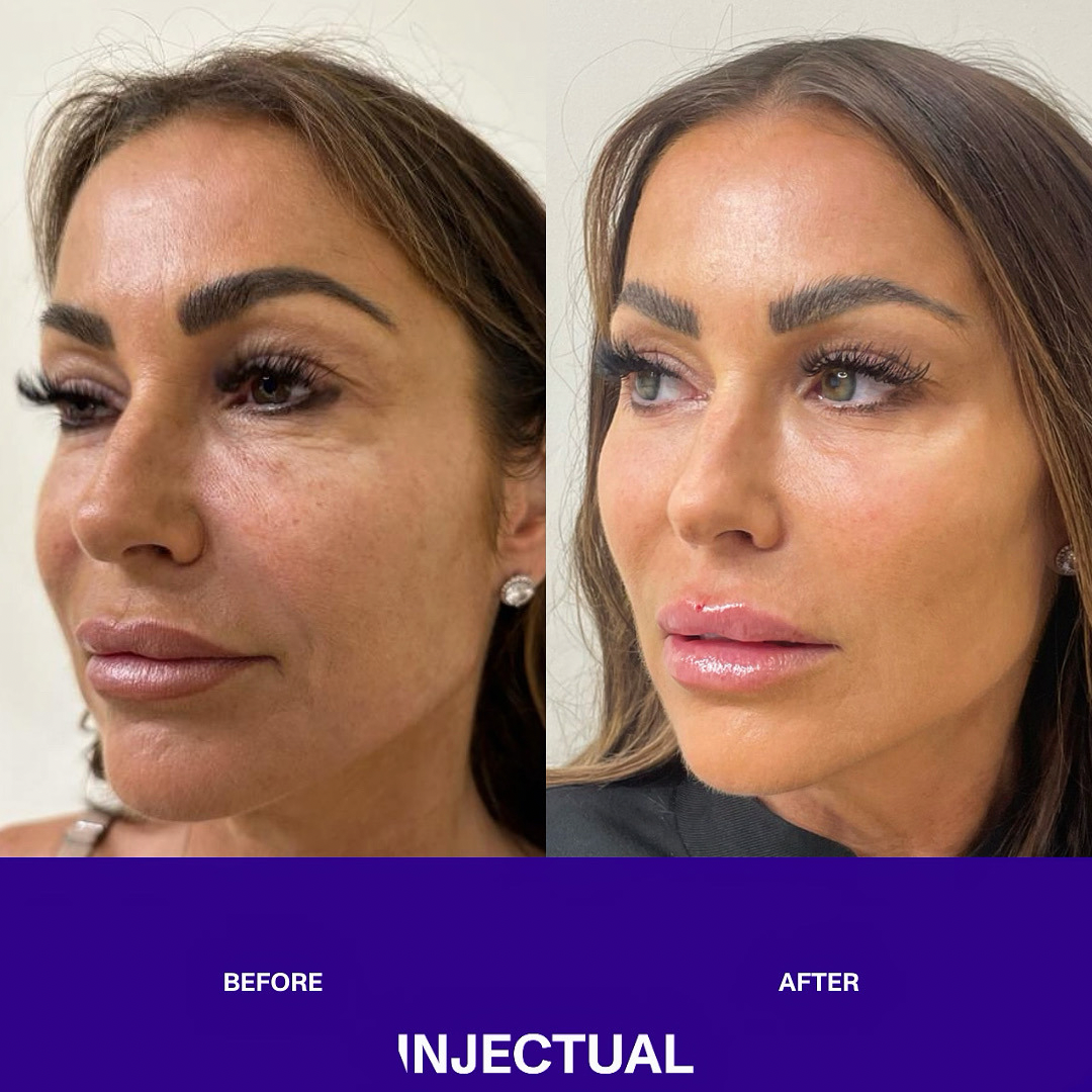Polynuclear Eye Injection Ameela® (Nucleadyn®) Under Eye Treatment | Injectual