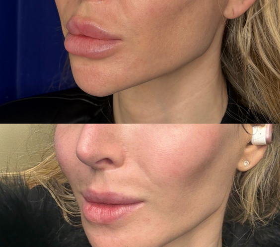 The Injectual Polynucleotide Cocktail XL