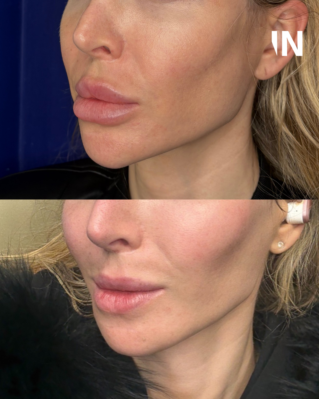 The Injectual Polynucleotide Cocktail XL