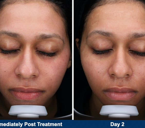 UltraClear Laser Skin Resurfacing