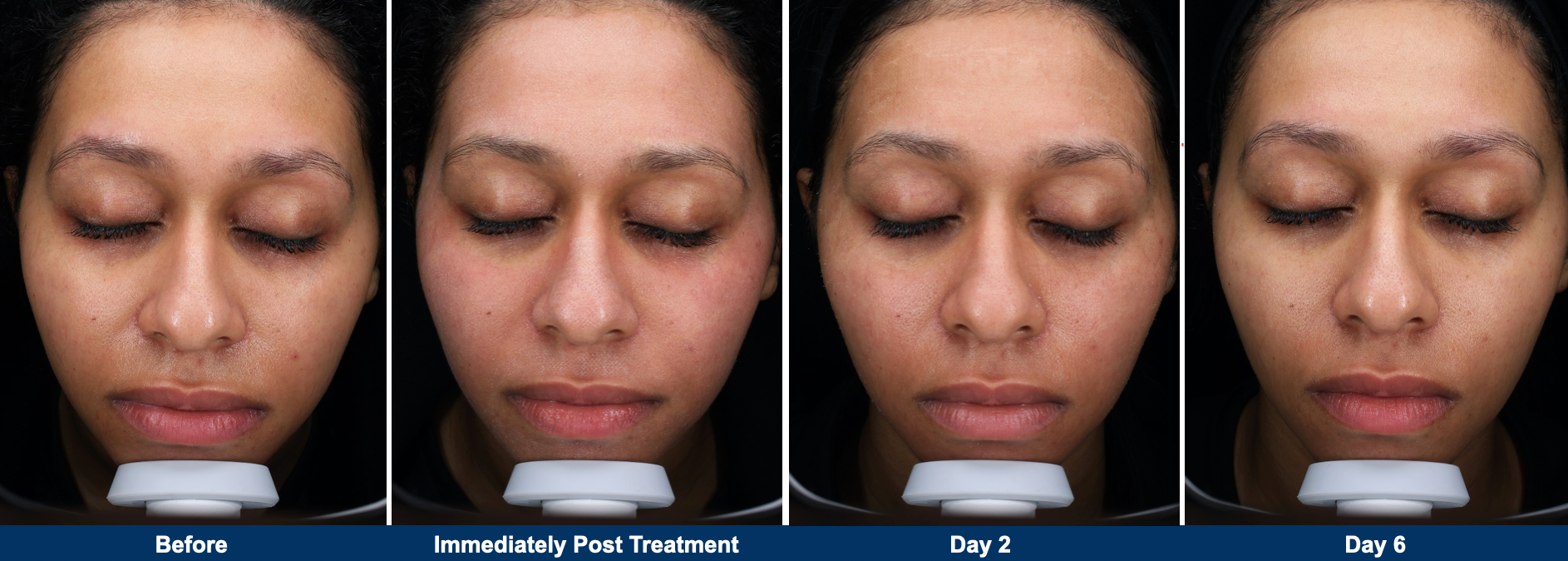 UltraClear Laser Skin Resurfacing