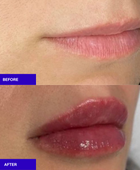 The INJECTUAL Lip