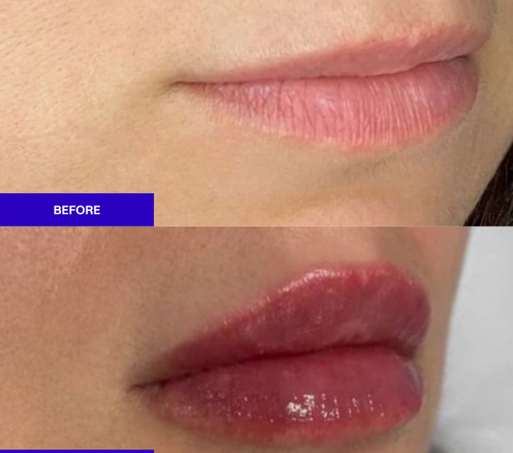 The INJECTUAL Lip