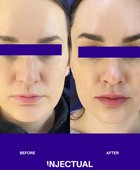 The INJECTUAL Artistic Transformation (Facelift)
