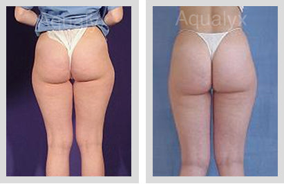 Aqualyx or Celluform Fat Dissolving