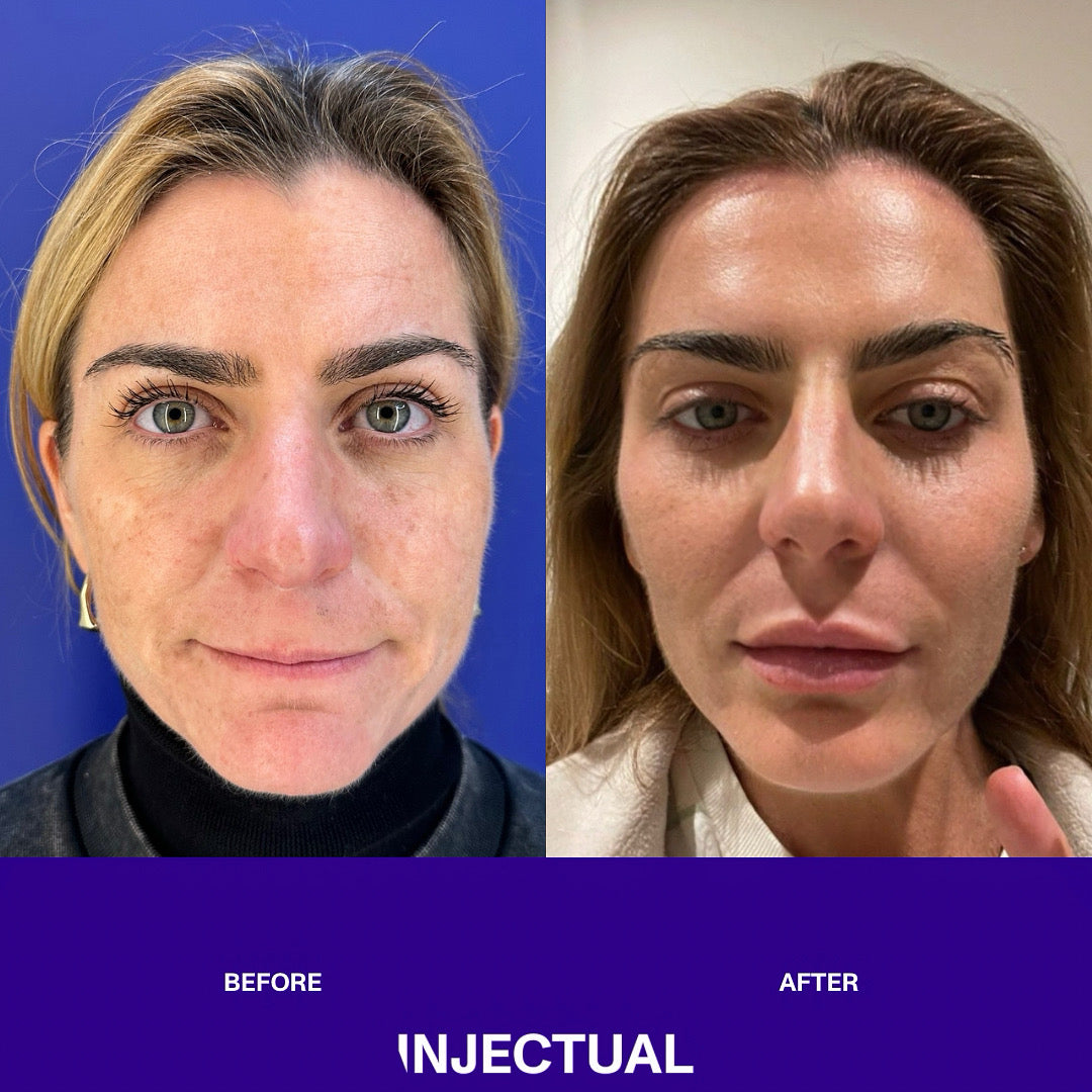 The INJECTUAL Artistic Transformation (Facelift)