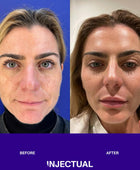 The INJECTUAL Artistic Transformation (Facelift)
