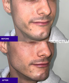 The INJECTUAL Artistic Transformation (Facelift)