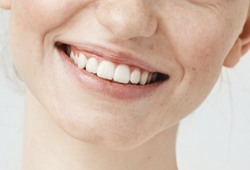 Gummy Smile Treatment