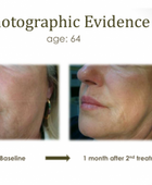 Profhilo® Skinbooster Face Treatment