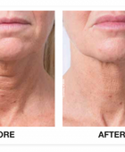 Profhilo® Skinbooster Face Treatment