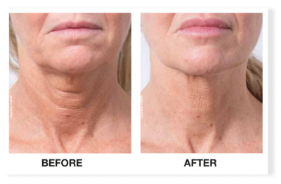 Profhilo® Skinbooster Face Treatment