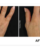 Profhilo® Skinbooster Face Treatment