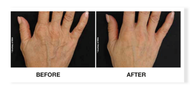 Profhilo® Skinbooster Face Treatment