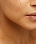 Chin Filler
