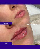 The INJECTUAL Lip