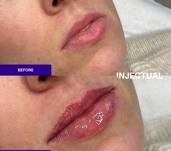 The INJECTUAL Lip