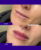 The INJECTUAL Lip