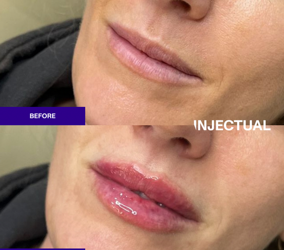 The INJECTUAL Lip