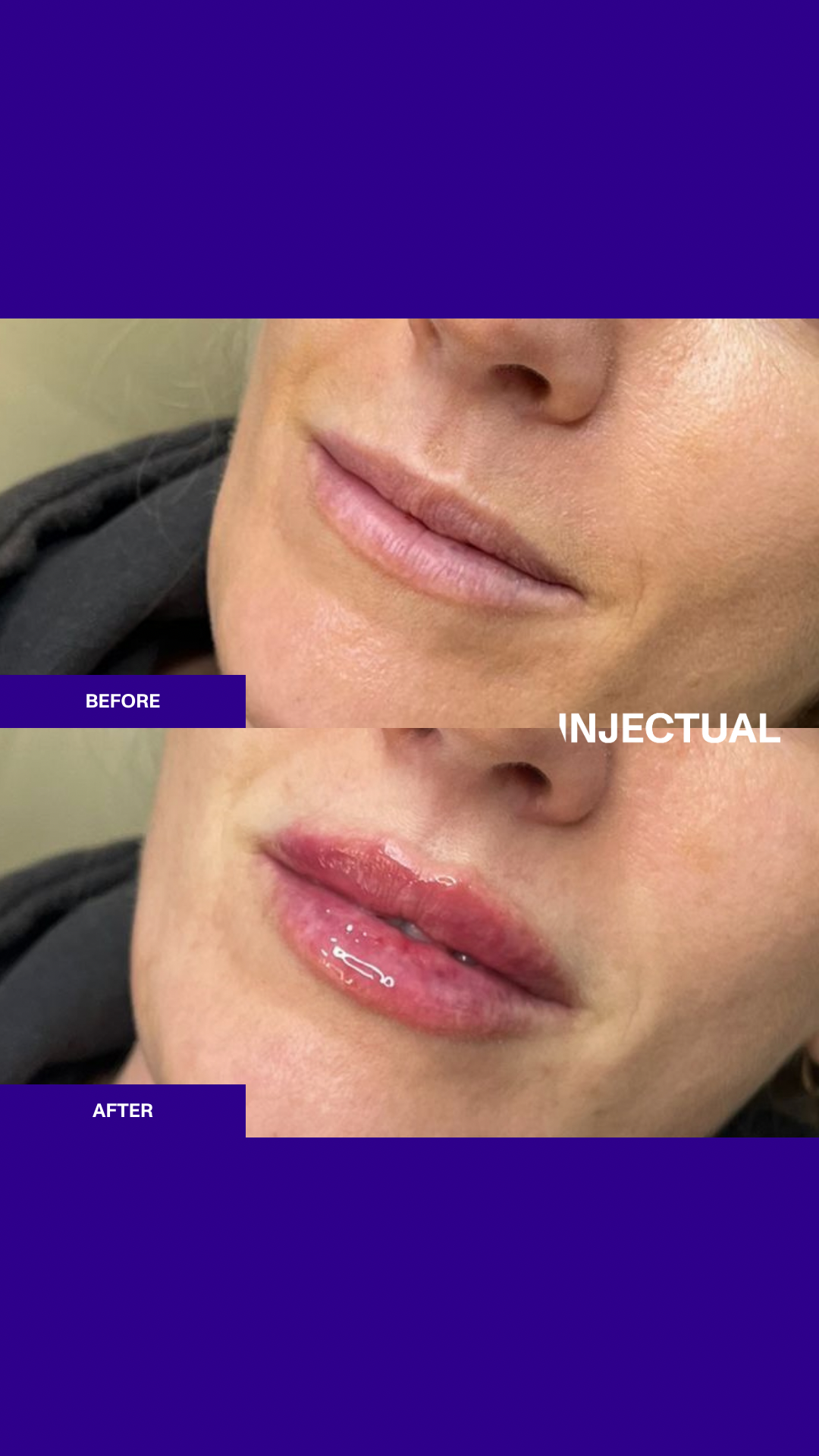 The INJECTUAL Lip